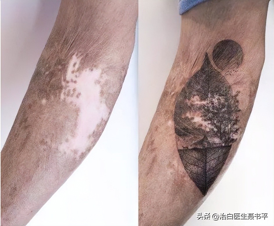 白癜风停止扩散纹身遮盖怎么样,女孩白癜风治好会再复发吗
