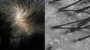 头皮屑特别多怎么去除最简单方法,头皮屑又多又痒怎么去除最有效