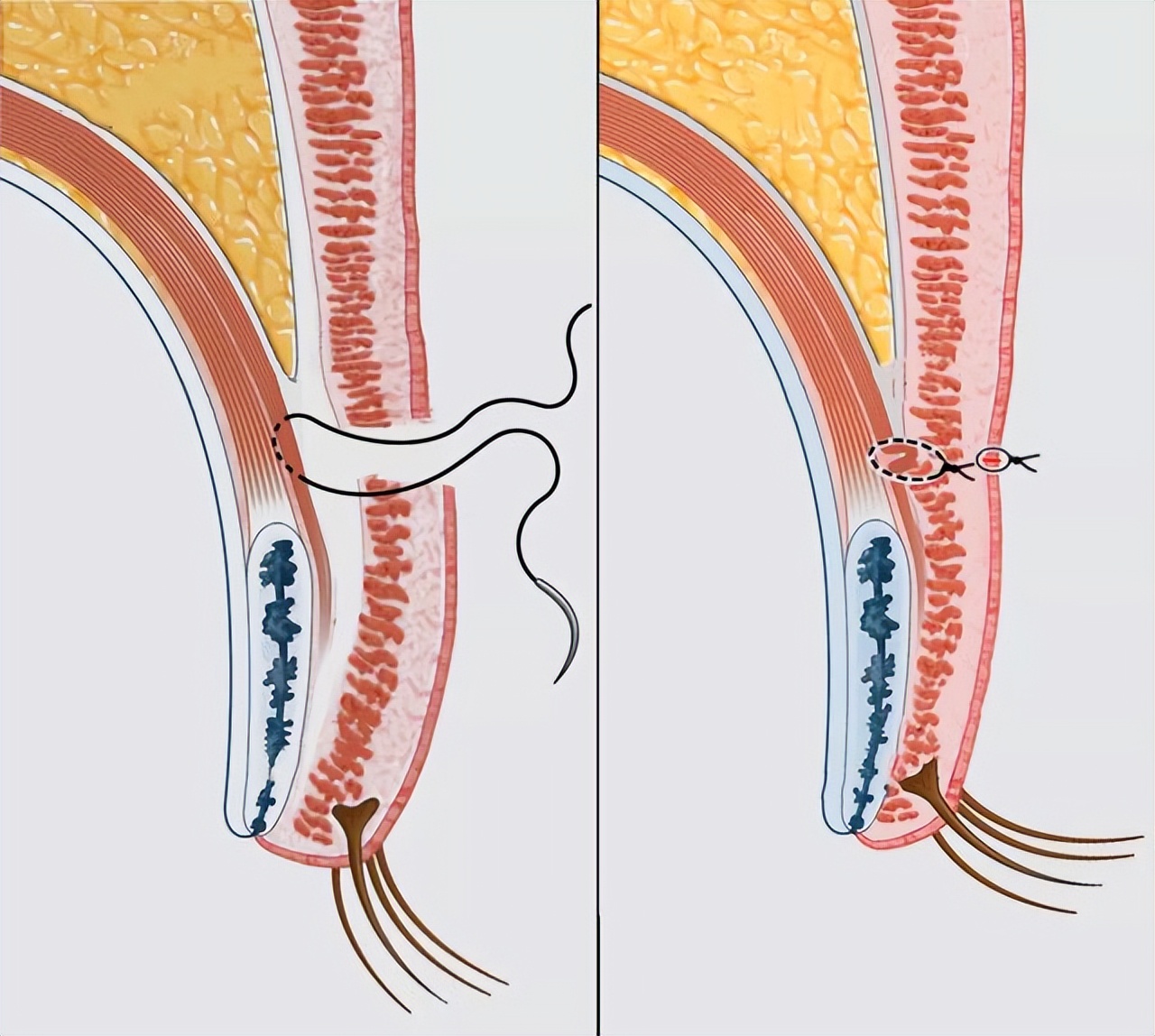 郑州修复双眼皮成功案例,郑州双眼皮修复全过程