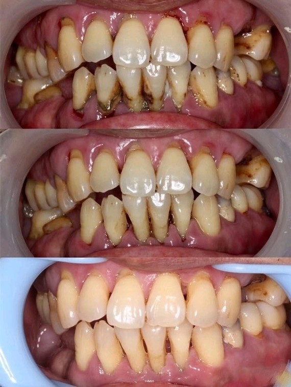 牙周肿了有什么危害,什么是牙周炎有什么危害