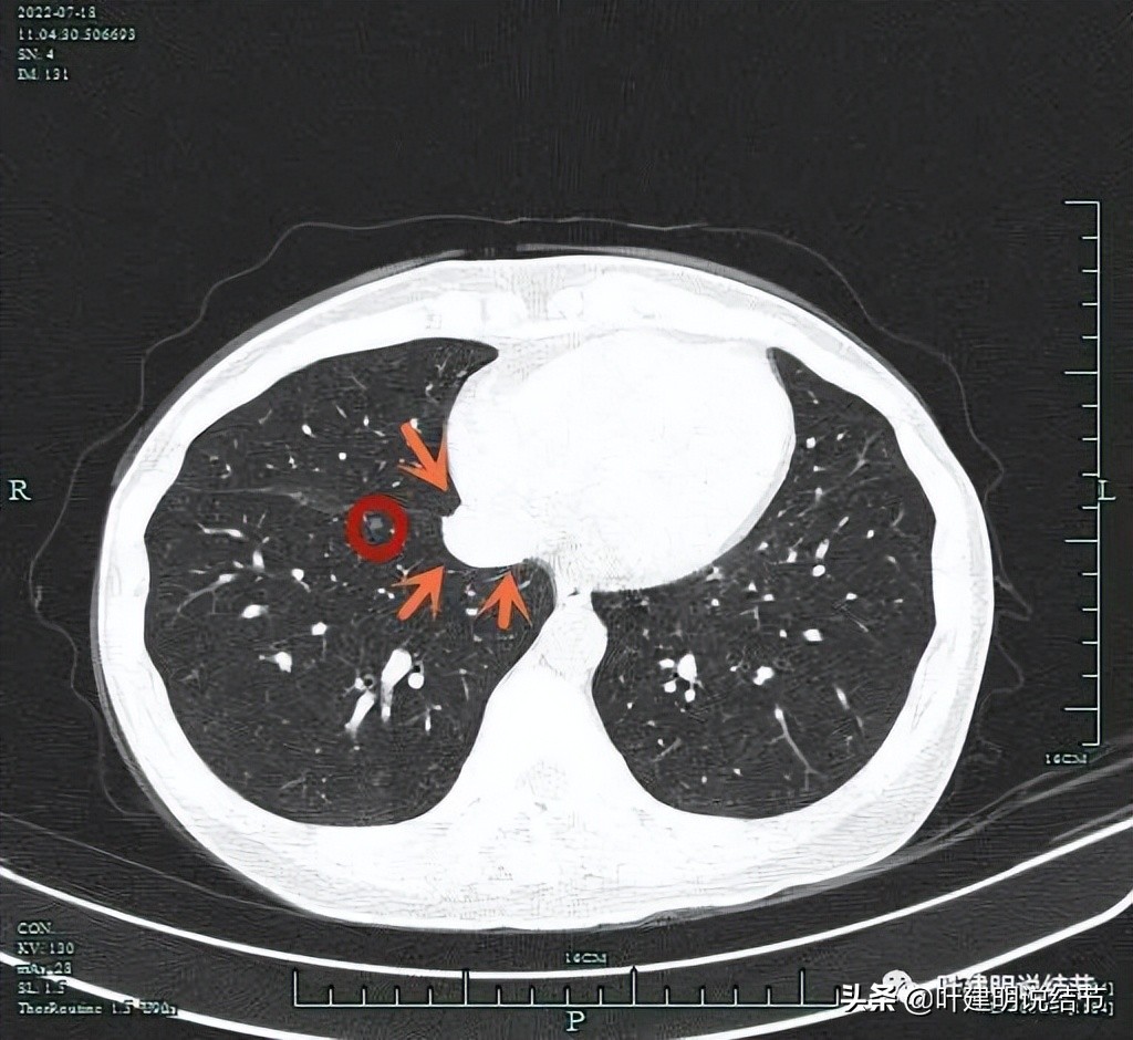 2cm的肺磨玻璃结节如何处理最合适,年轻女人磨玻璃结节