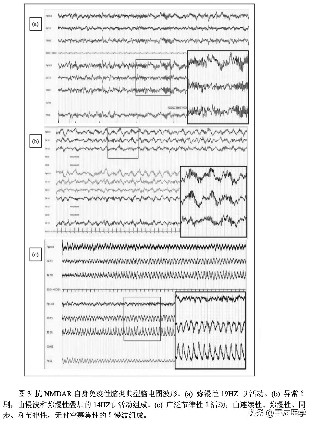 重症脑炎后遗症能恢复得过来吗,脑炎治疗指南最新