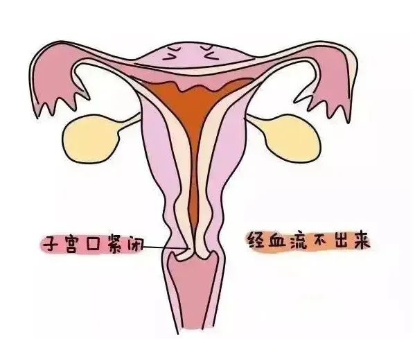 12岁小姑娘急性腹痛，原来是处女膜无孔