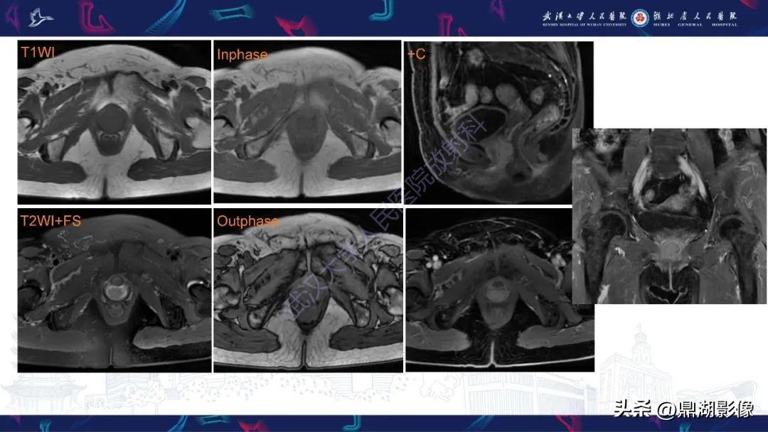 阴道肉瘤的早期症状,阴道里长肉瘤是啥症状