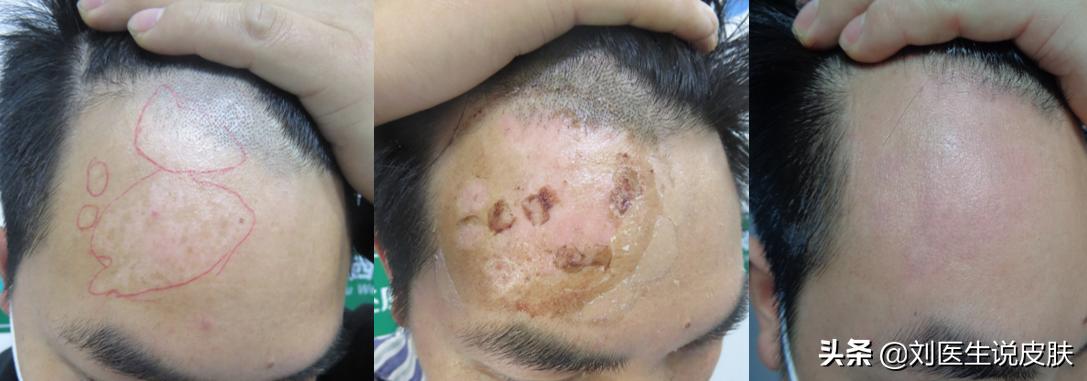 2020治疗白癜风的方法,2022年白癜风能治好吗