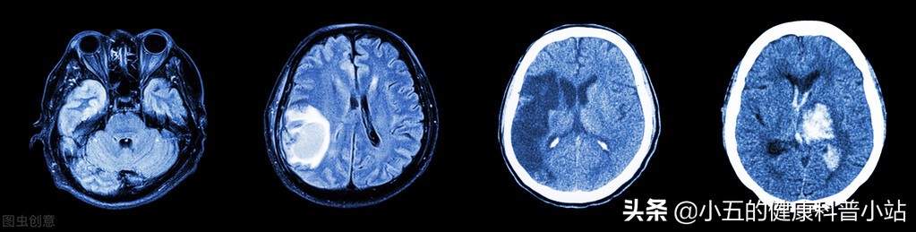 活血化瘀冠心病,冠心病人能吃心脑宁胶囊吗