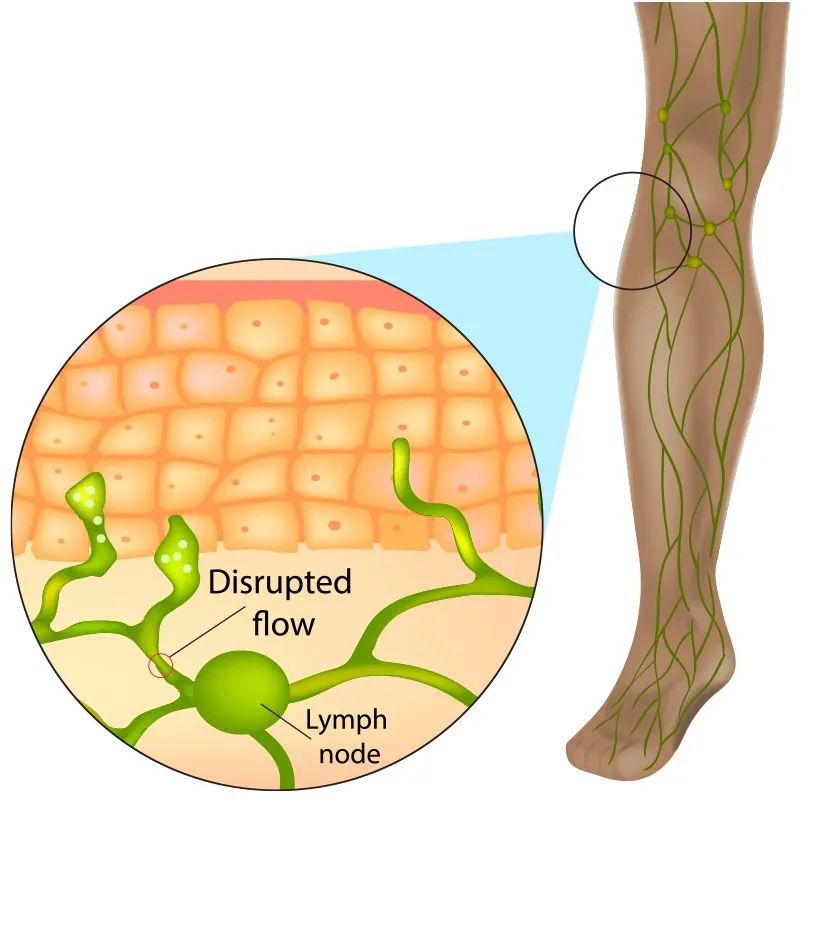 足踝术后怎么消肿,足跟骨术后肿胀如何消除