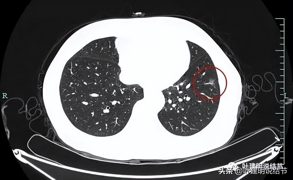 辽宁省肺结节手术哪家医院好,辽宁肺结节手术医院