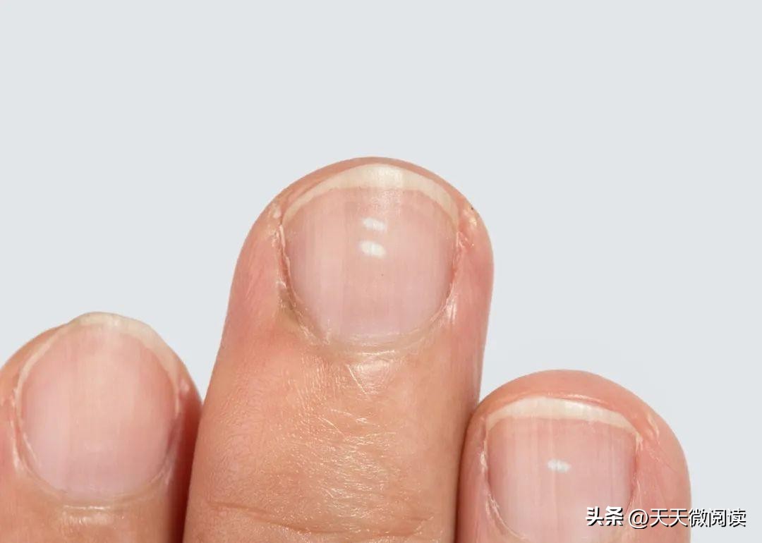 指甲有竖纹口臭老放屁是怎么回事,指甲有竖痕代表身体哪里不健康呢