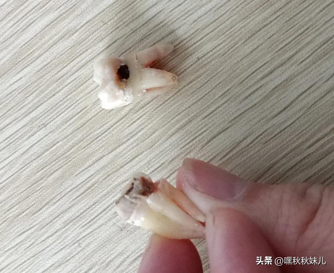 拔牙患者的感觉,智齿拔了以后感觉好奇怪