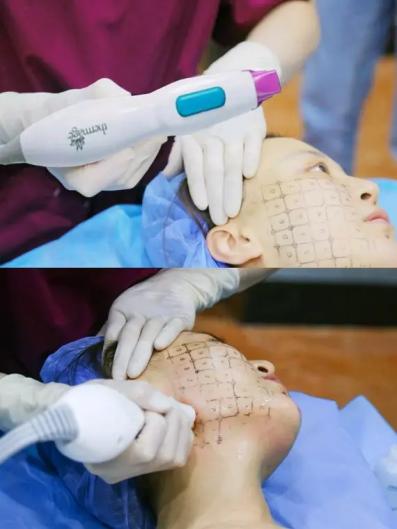 九院面部年轻化有哪些项目,40岁做什么医美项目可以提升脸部