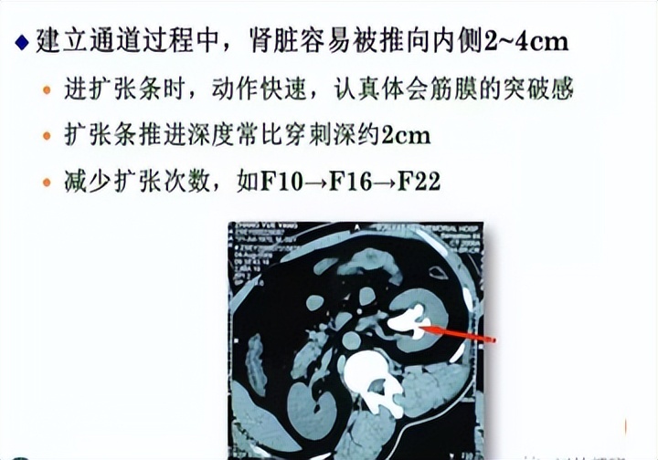 明知山有虎,偏向虎山行——肾斗士VS肾结石