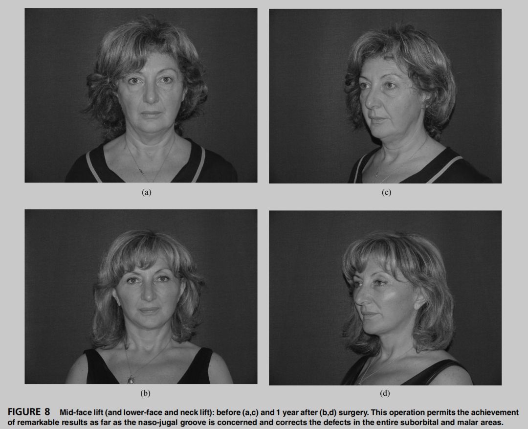 印第安纹解剖学,印第安纹分型对策