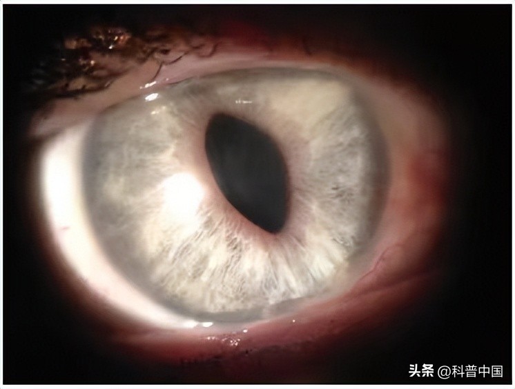 瞳孔三角形后遗症,瞳孔变成三角形是什么原因