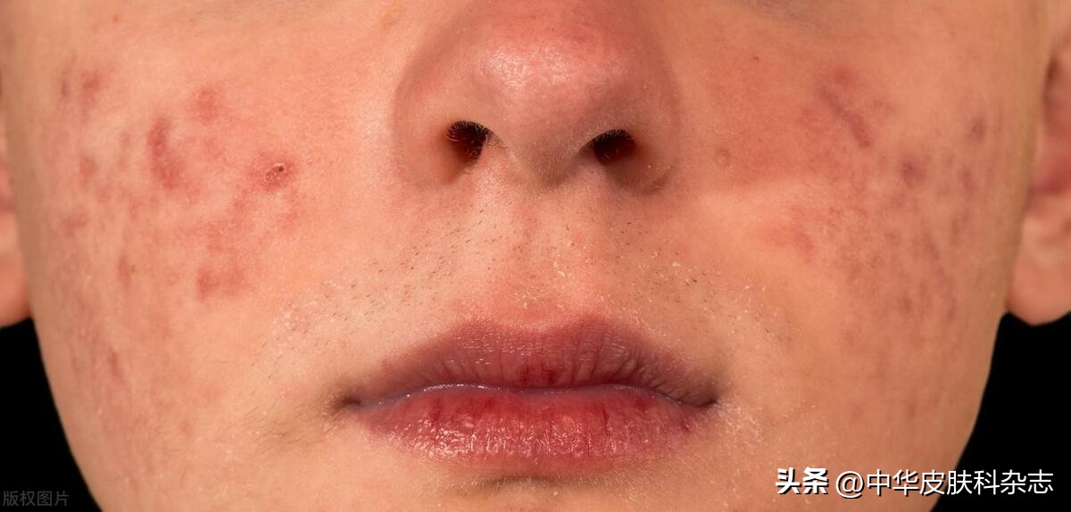 反常性痤疮用什么药,反常痤疮