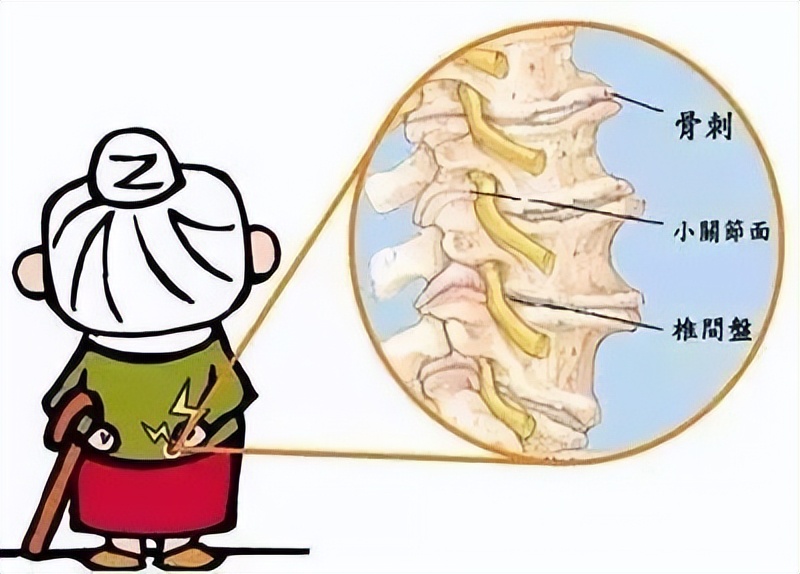 什么叫做骨刺骨刺都长在什么地方,什么是骨刺能根治吗