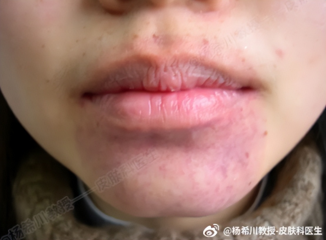 老公身上有吻痕可作为出轨证据吗,吻痕是出轨证据吗