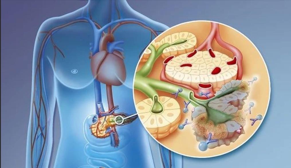 上腹部疼如何区分胃病和胰腺癌,胃痛不一定都是胃病要警惕胰腺癌