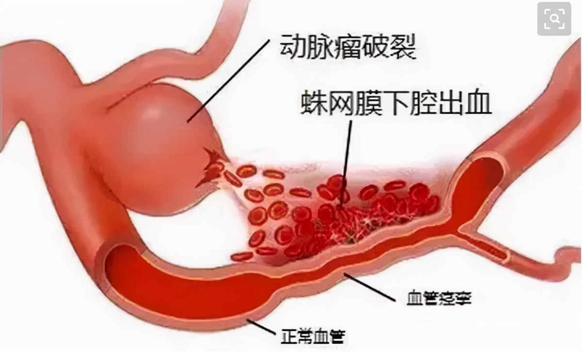 脑动脉瘤是否必须手术,脑动脉瘤必须手术治疗吗