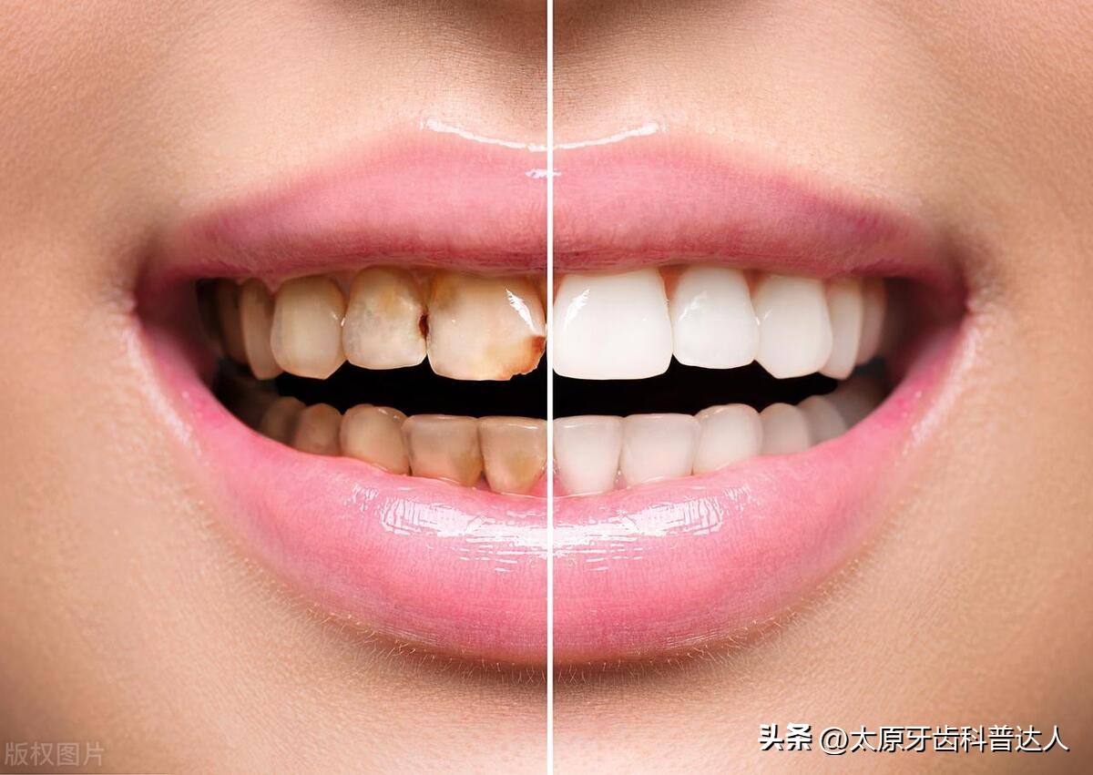 氟斑牙洗牙能变白吗图片高清,氟斑牙用什么方法进行美白