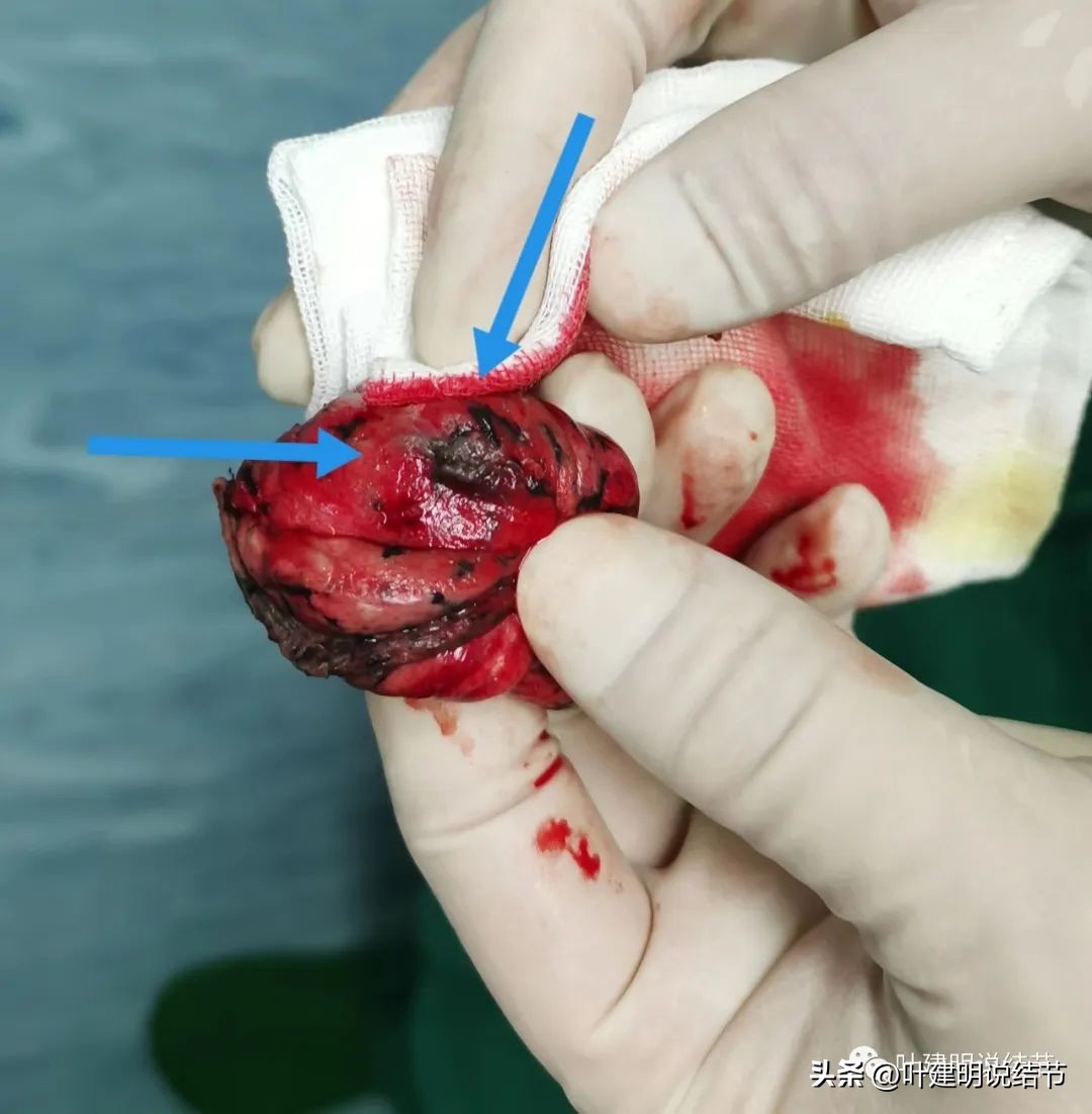 肺楔形切除肺功能降低,肺楔形切除需要缝合吗