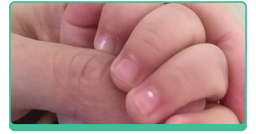 白斑、薄脆、凹陷，娃指甲有异常，不是缺营养，可能暗藏疾病