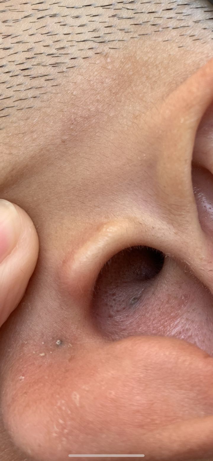 20年的黑头有多大,世界上最长的黑头到底有多长