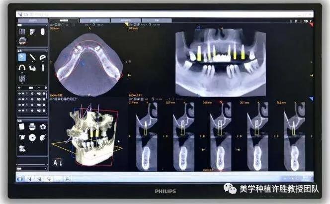 骨增量是什么,牙槽骨情况决定种植牙位置