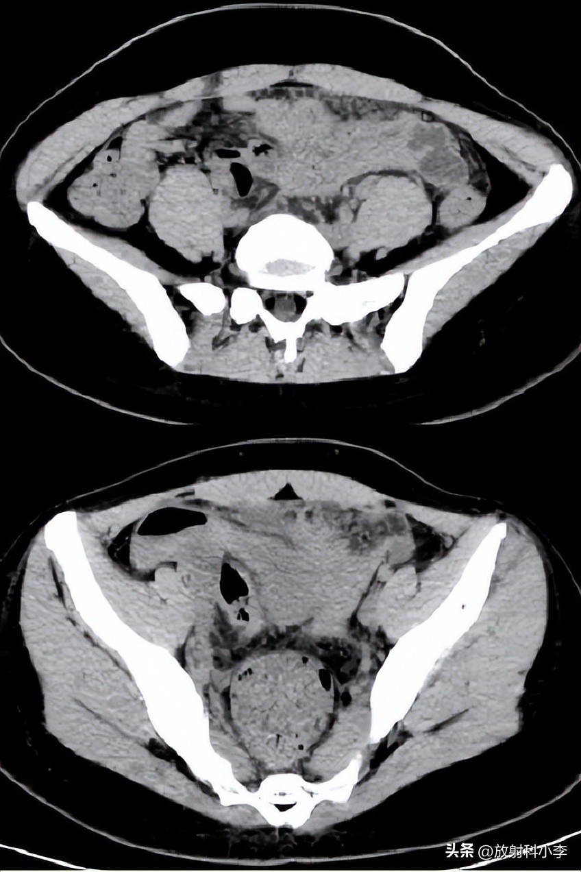 妇科急腹症的ct表现,妇科急腹症的诊断与治疗