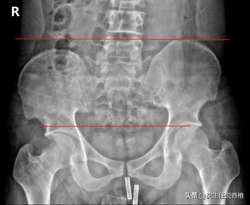 腰腿疼痛、骨盆不正，很可能是长短腿导致的，如何治疗？