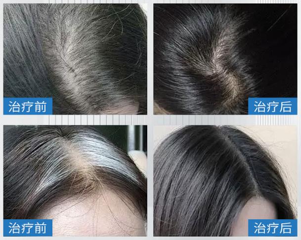 如何有效自然增多发量,发量少怎么快速增多