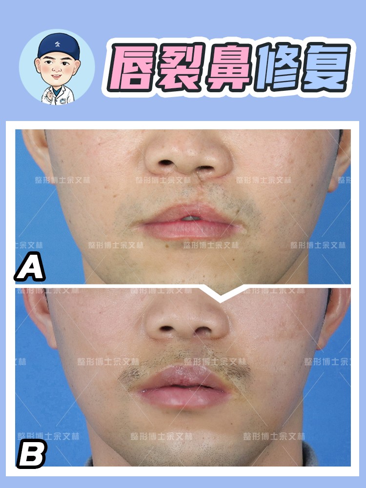 唇裂红唇修复,唇裂手术前后对比图