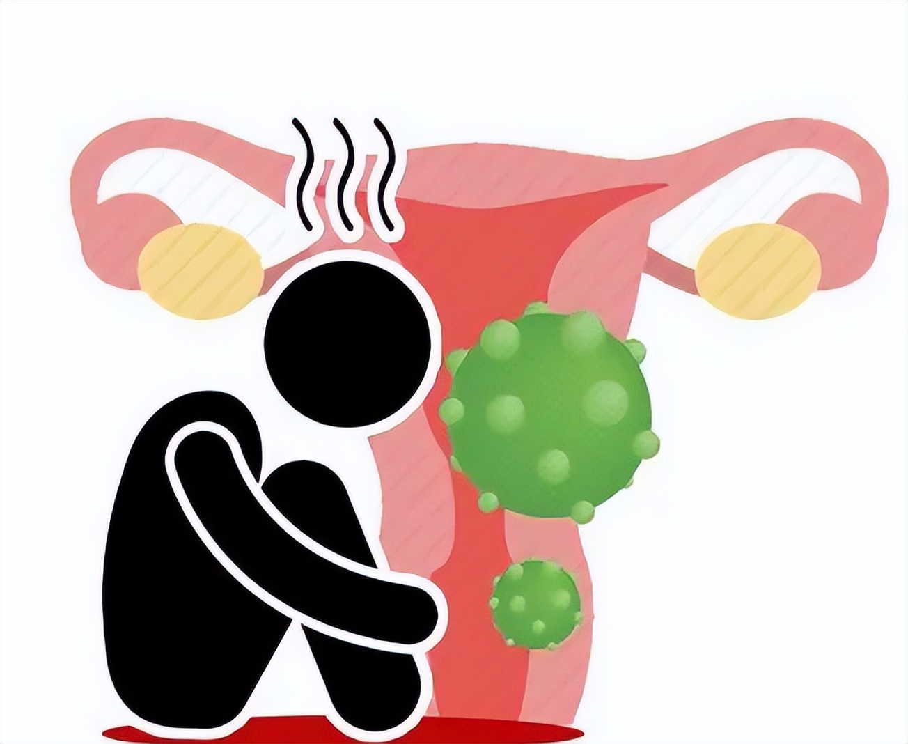 宫颈癌放疗时的注意事项,宫颈癌根治性放疗方案