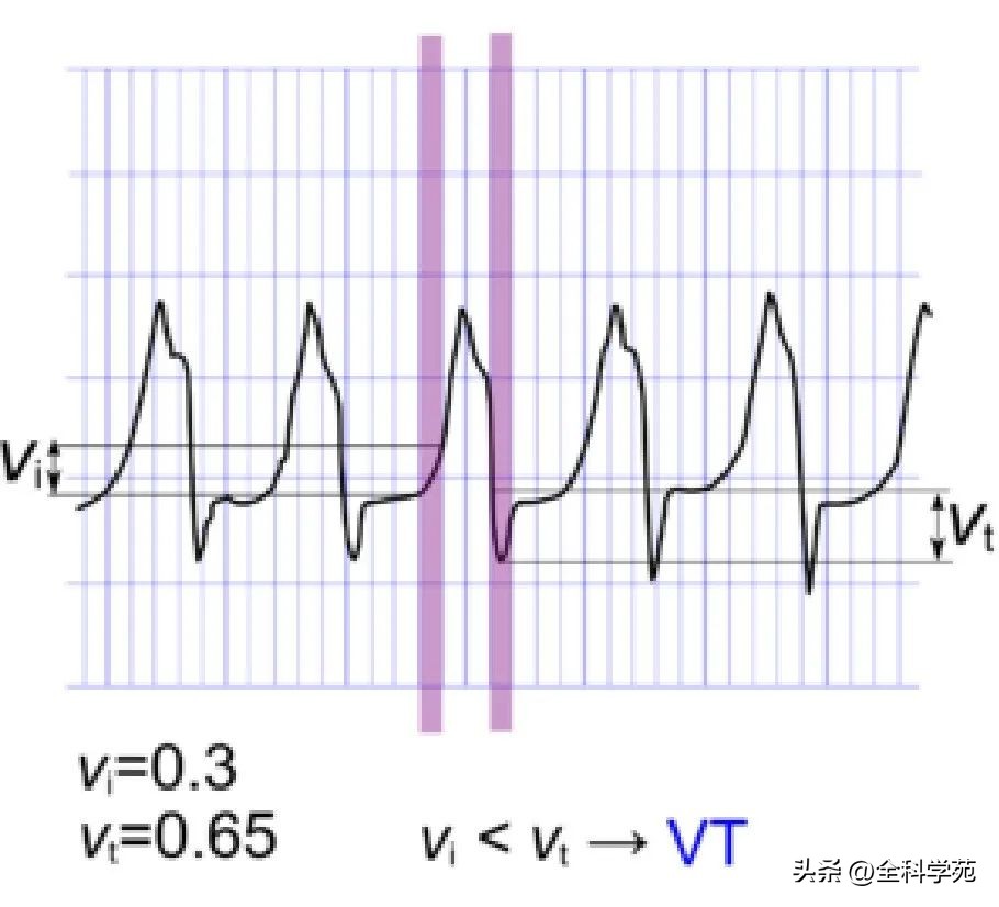 心电图上表现为宽qrs波,心电图中qrs是代表心动过速吗