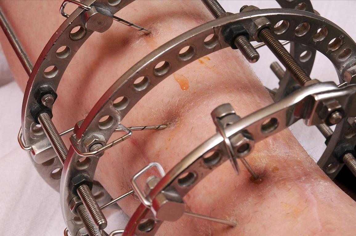 德国断骨增高20厘米,德国最新断骨增高术