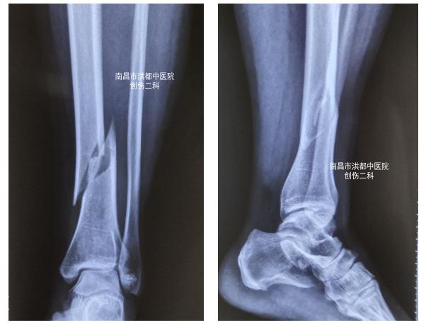 女子滑倒致小腿骨折，医生巧术让患者“快速复位”