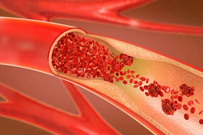 76岁老人心脏房颤是怎么引起的,80多岁老人持续房颤意味着啥