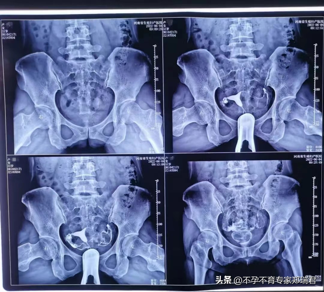 一侧输卵管不通能怀孕吗,输卵管一边通一边不通能怀孕吗