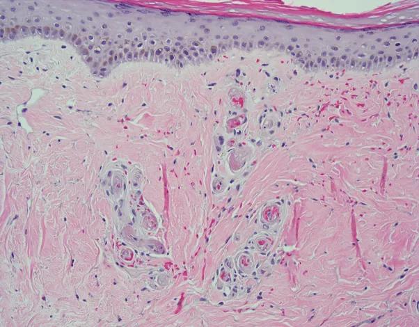 青斑血管病可以治愈吗,青斑是皮肤病还是血管病