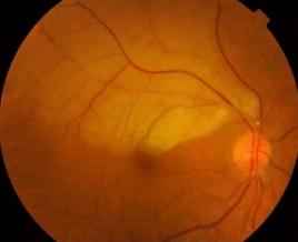 注射填充危险吗,注射栓塞后的处理