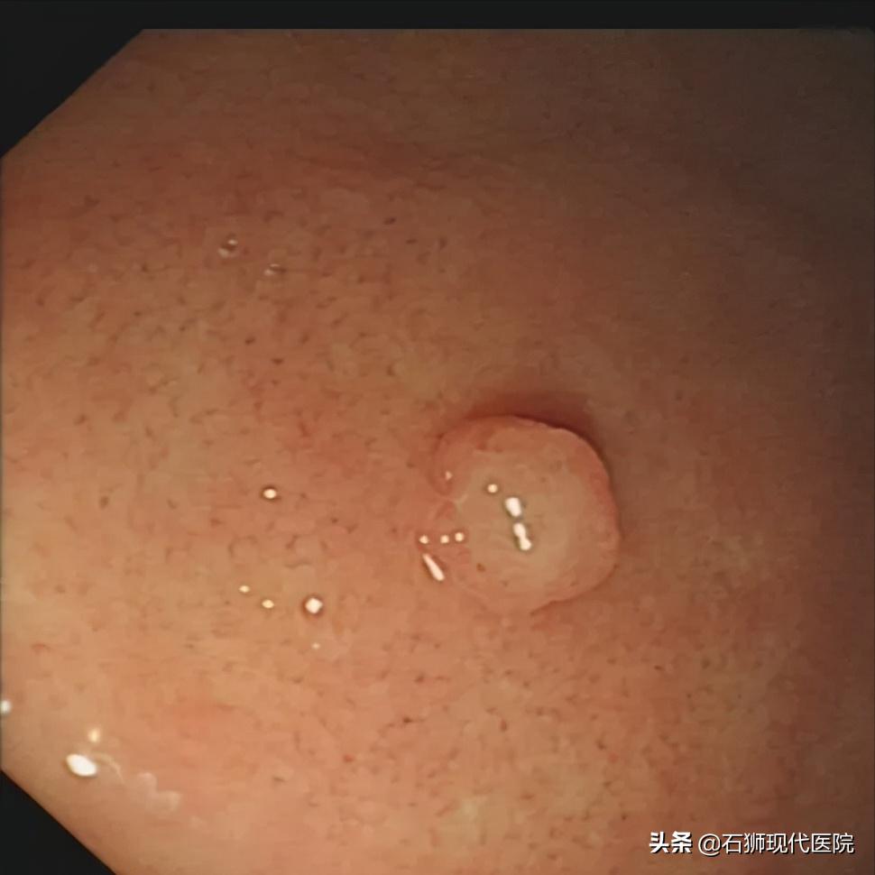 有哪些人不合适做胃镜,石狮市医院做胃镜肠镜技术可以吗