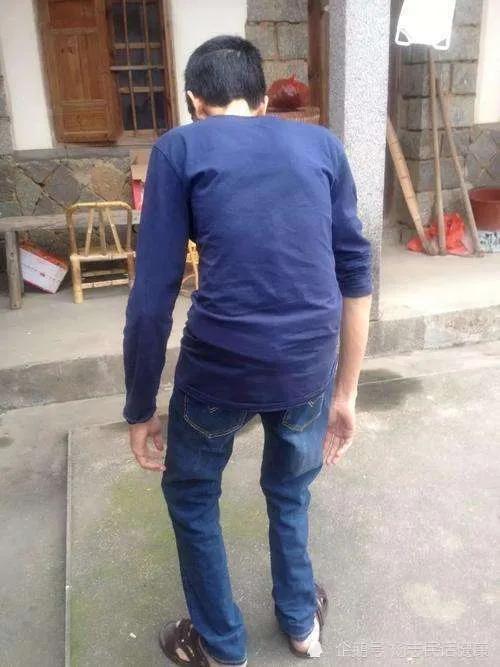 当归四逆汤加减治疗强直性脊柱炎,强直性脊柱炎用葛根汤治疗