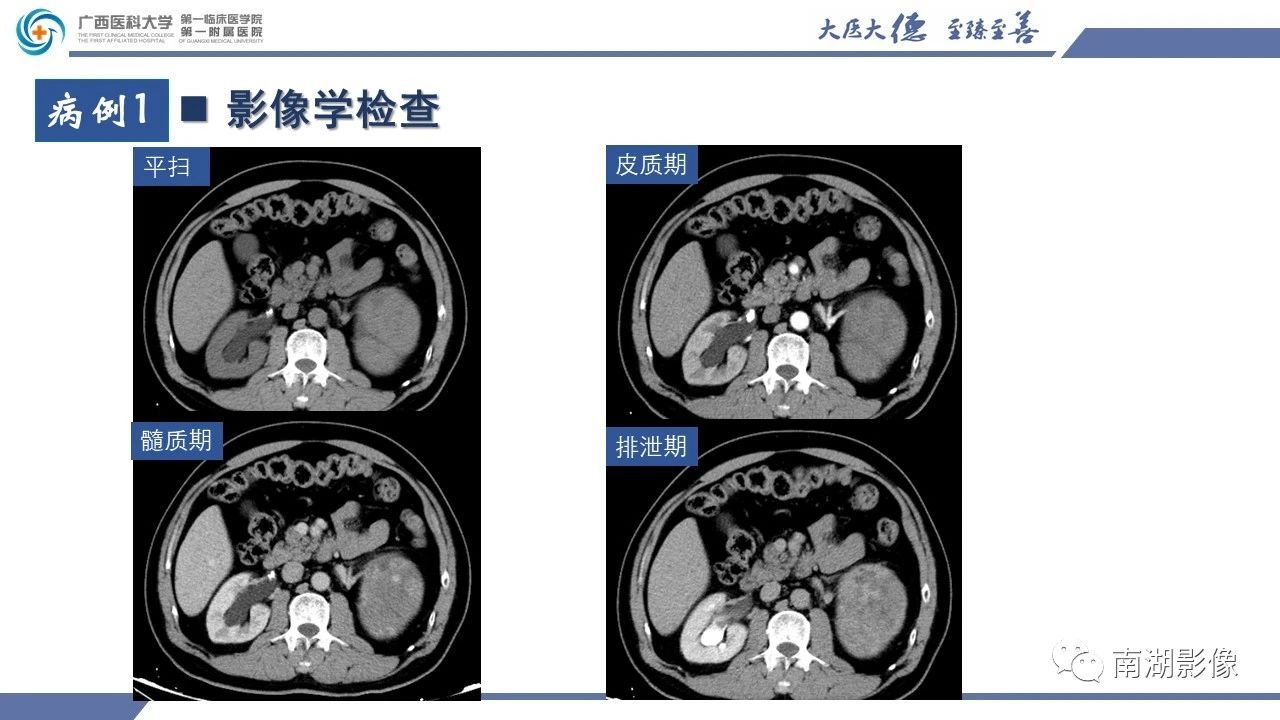 肾上腺海绵状血管瘤,肾上腺血管瘤是良性还是恶性