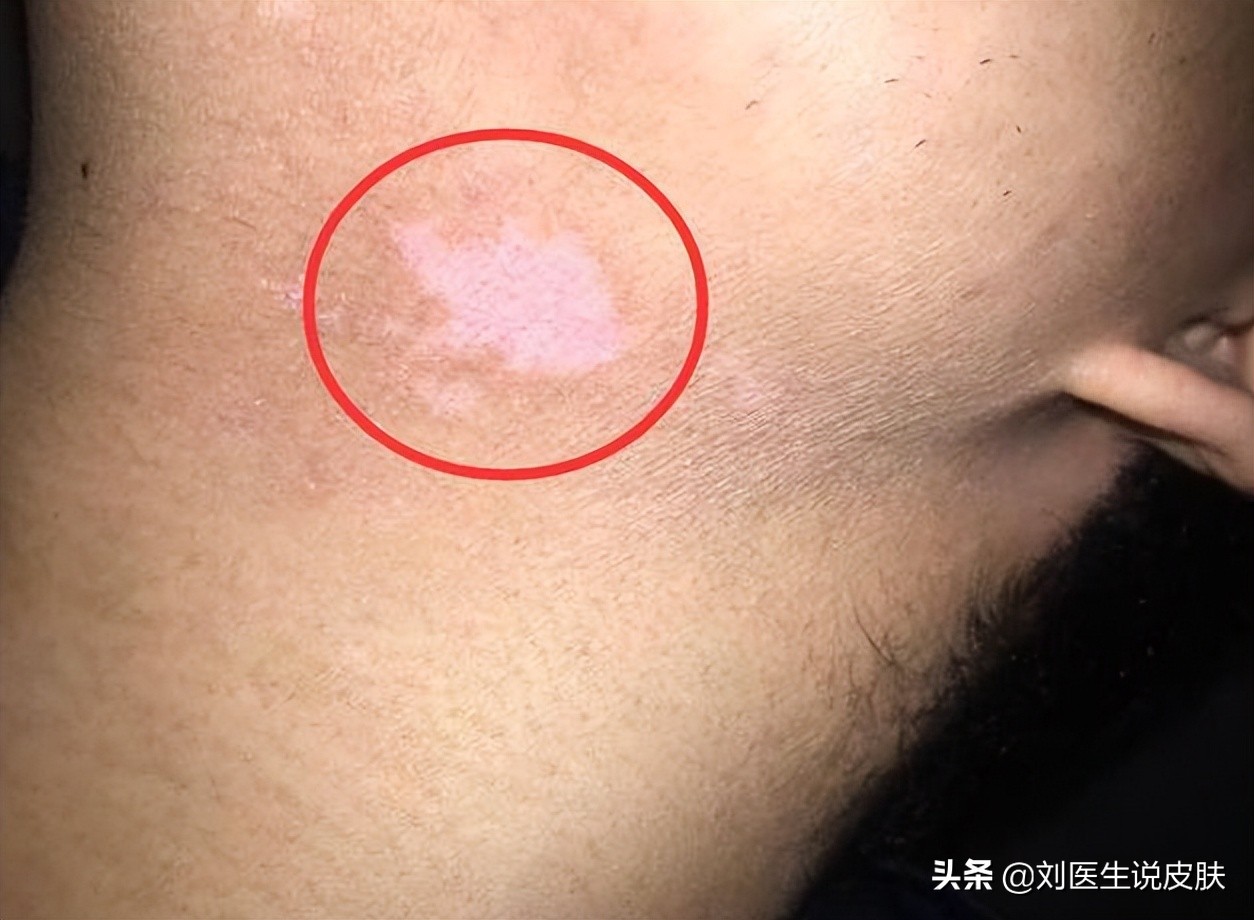 晕痣型白癜风初期和中期的区别,早期晕痣型白癜风怎么治疗