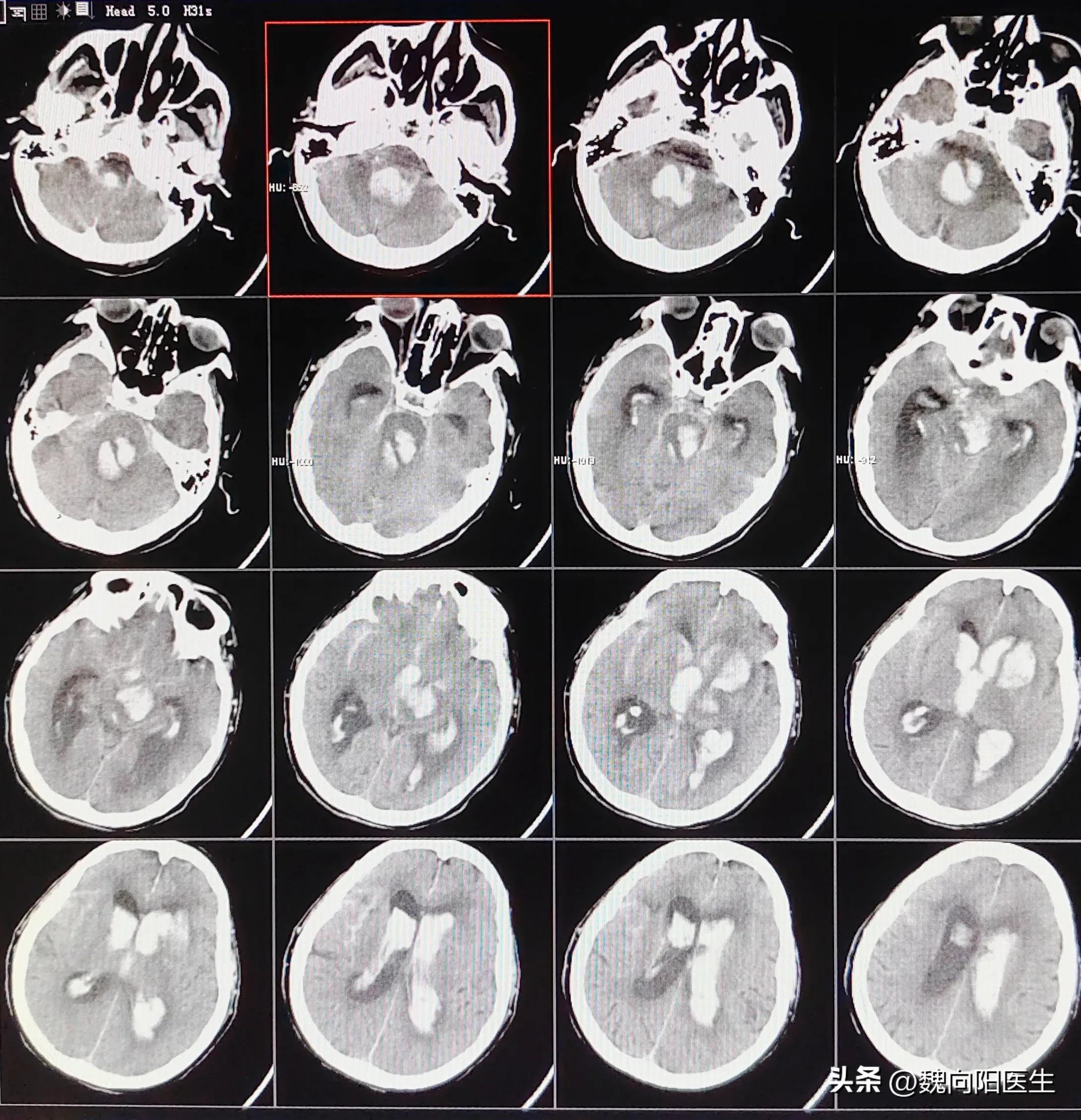 脑出血的人值得救吗,脑出血保守治疗的人