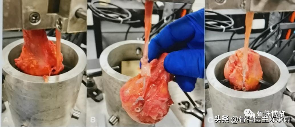 肱二头肌长头肌腱断裂超声报告,上臂肱二头肌