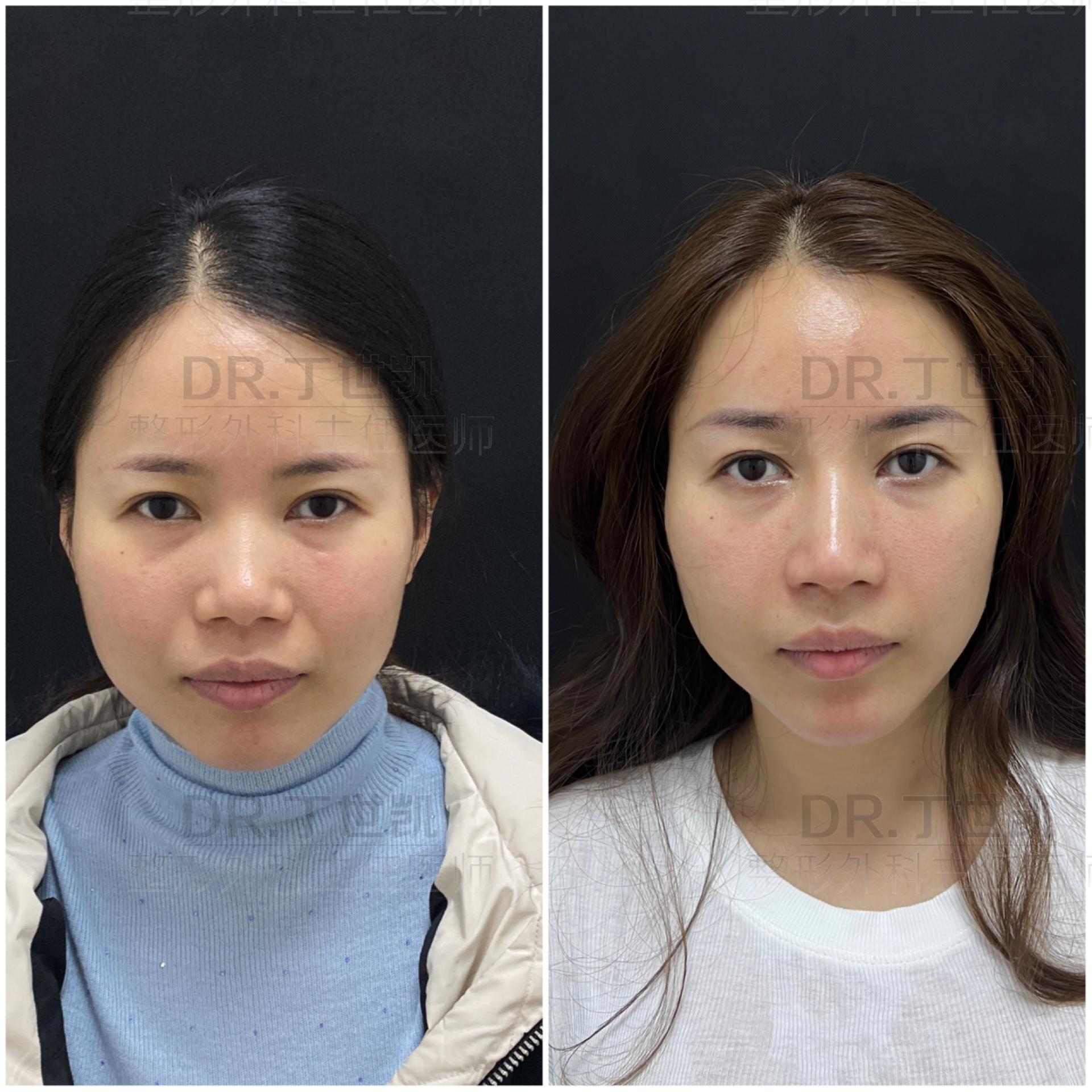 隆鼻三个月鼻子发红不痛不痒,隆鼻发炎鼻尖发红吃什么药