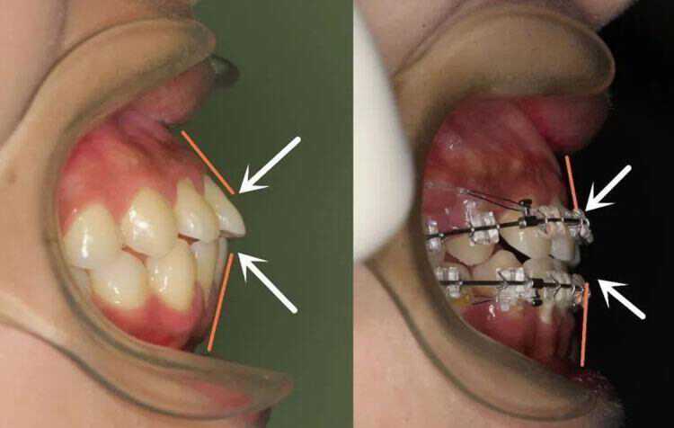 塌山根塌鼻梁怎么拯救,没山根塌鼻梁凸嘴怎么改善