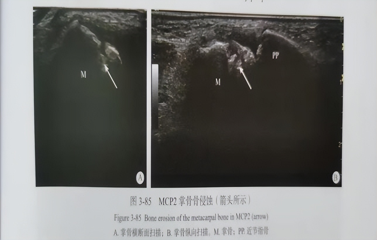 什么是肌骨超声为什么风湿病患者要做肌骨超声？