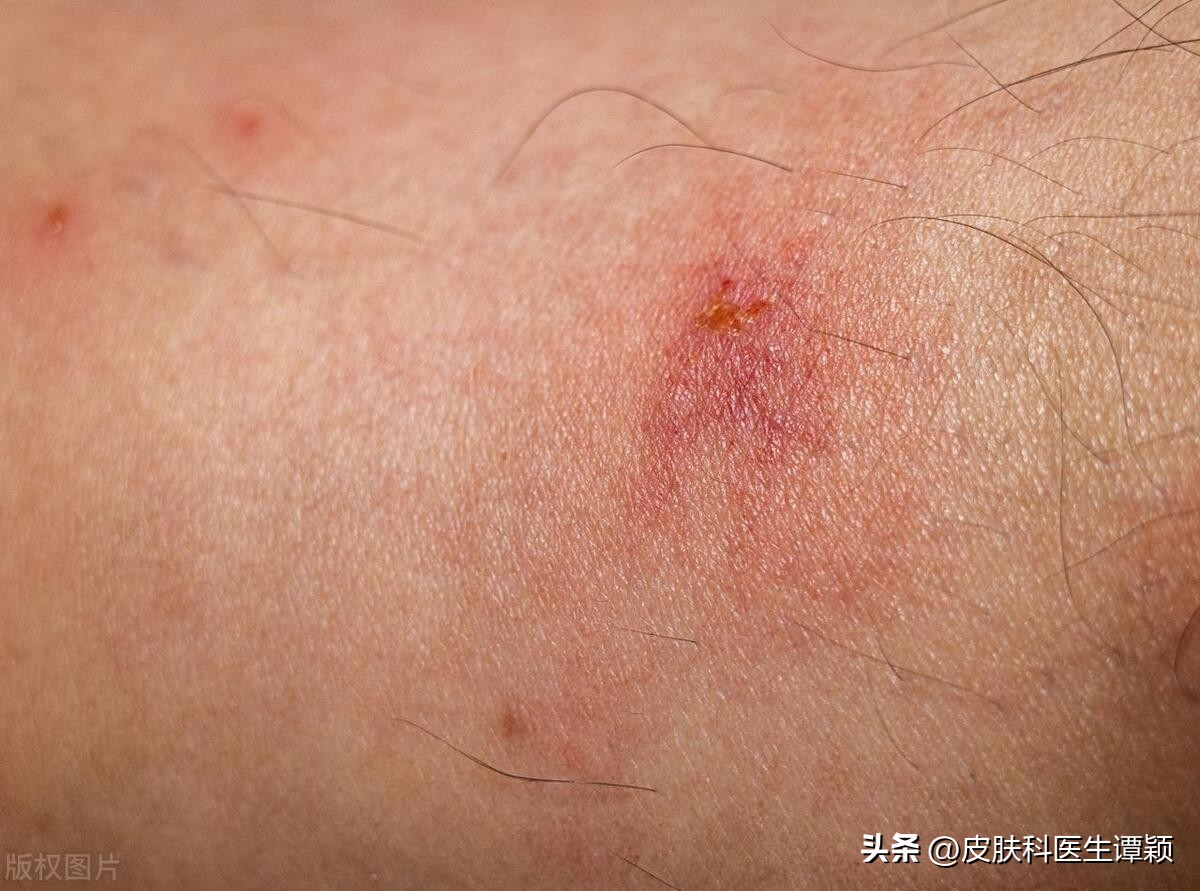 怎么用药物防止阴虱病,皮肤科检查阴虱流程